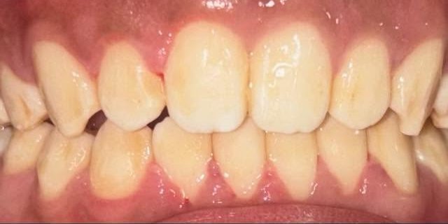 After gaps closed with braces at Fulo Dental Clinic, Sorsogon