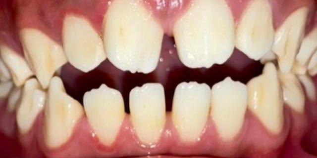 Before gaps closed with braces at Fulo Dental Clinic, Sorsogon