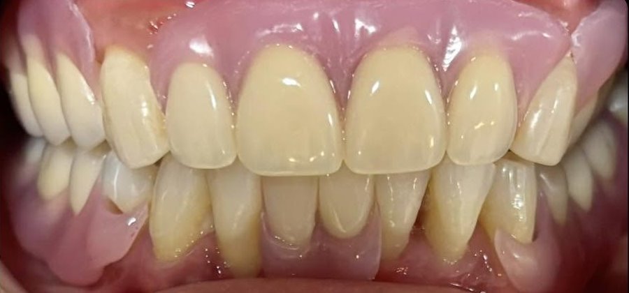 After full smile restored with dentures at Fulo Dental Clinic, Sorsogon