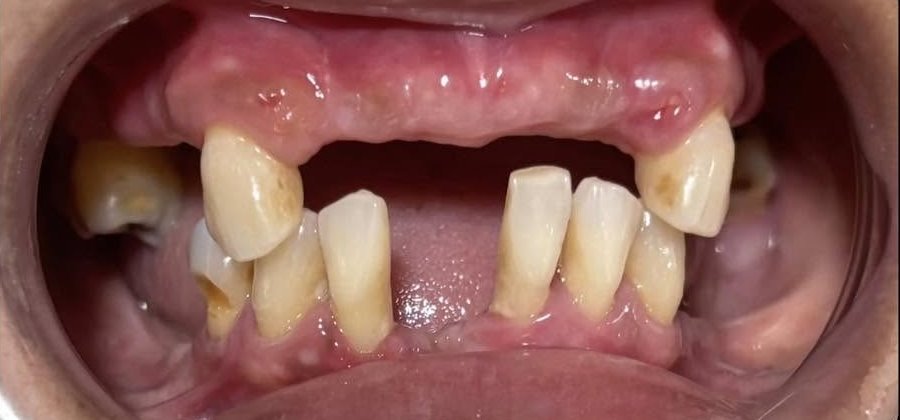 Before full smile restored with dentures at Fulo Dental Clinic, Sorsogon