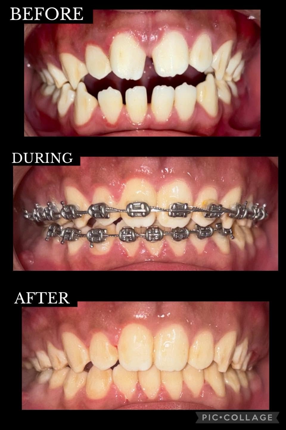 Before and after braces: before, during, after at Fulo Dental Clinic, Sorsogon
