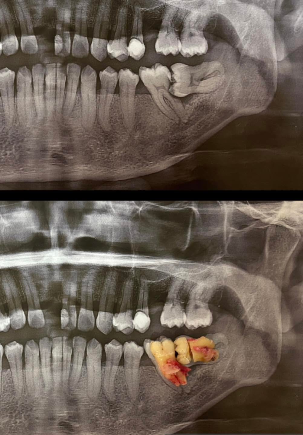 Before and after impacted wisdom tooth removal at Fulo Dental Clinic, Sorsogon