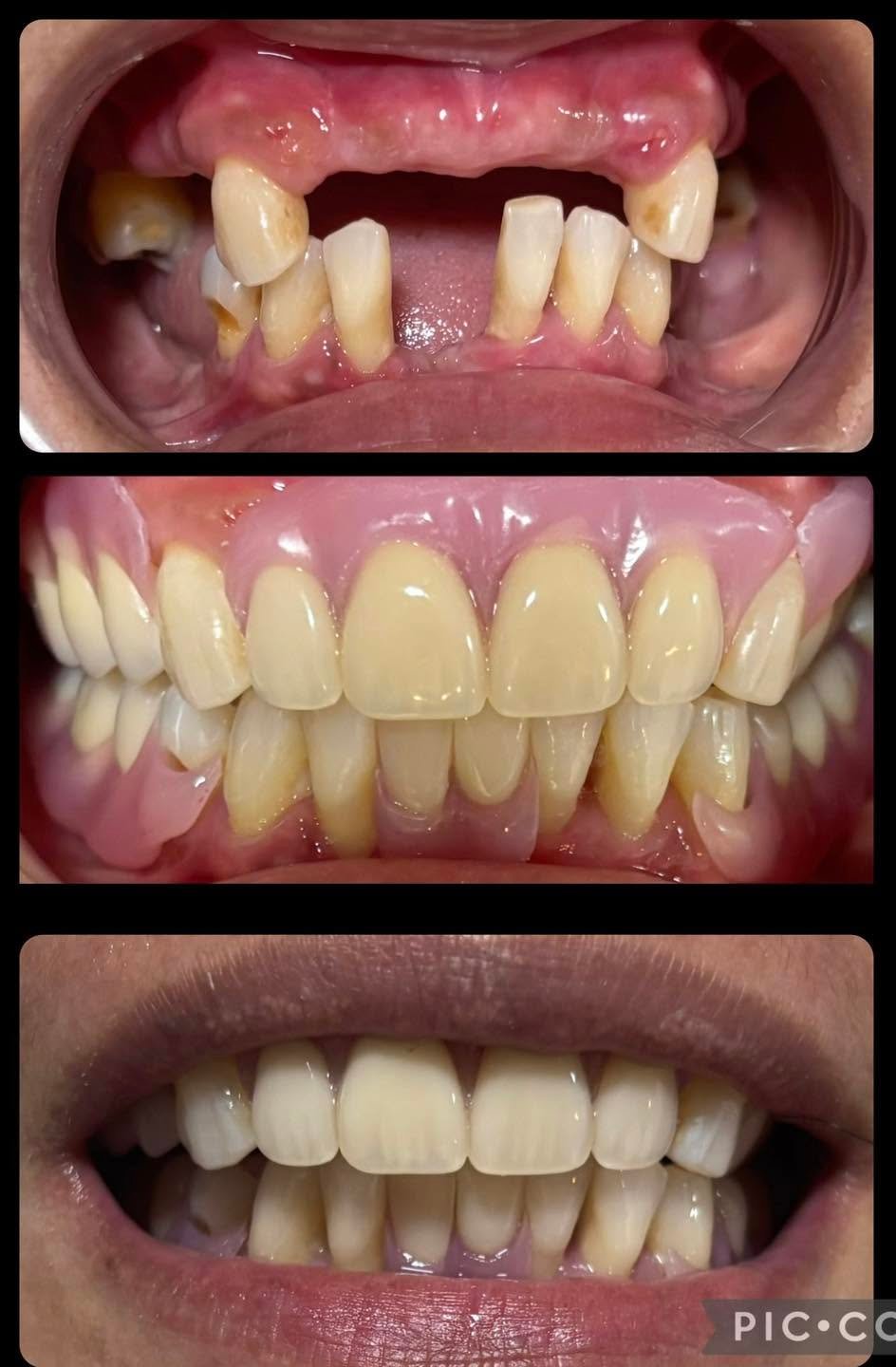 Before and after full smile restoration at Fulo Dental Clinic, Sorsogon