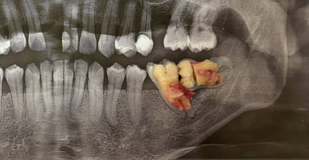 After impacted wisdom tooth removed at Fulo Dental Clinic, Sorsogon