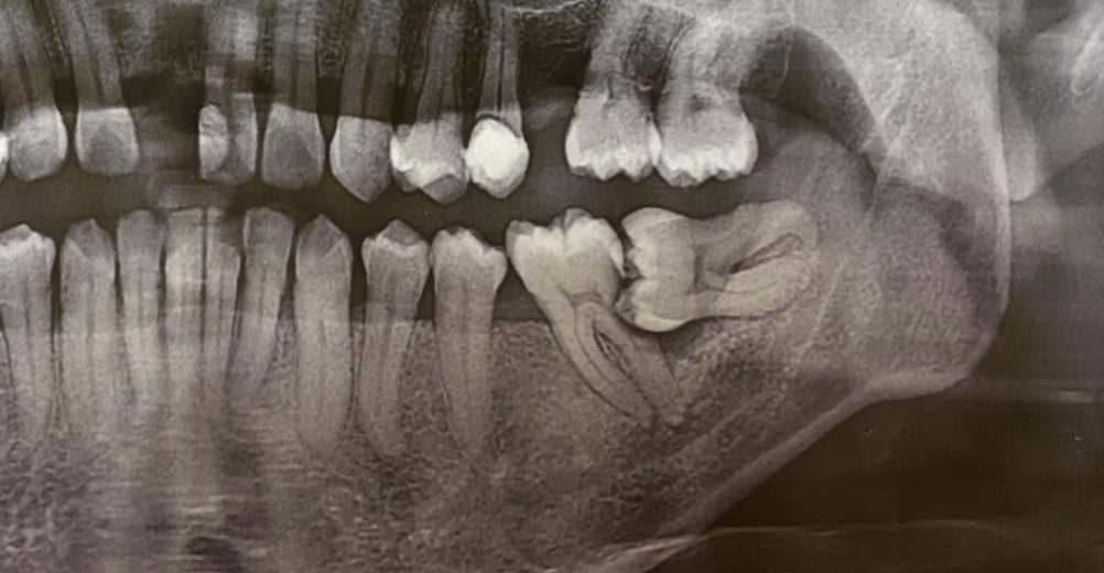 Before impacted wisdom tooth removed at Fulo Dental Clinic, Sorsogon